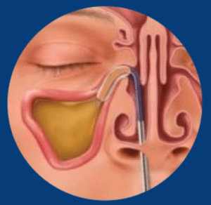 balloon sinuplasty