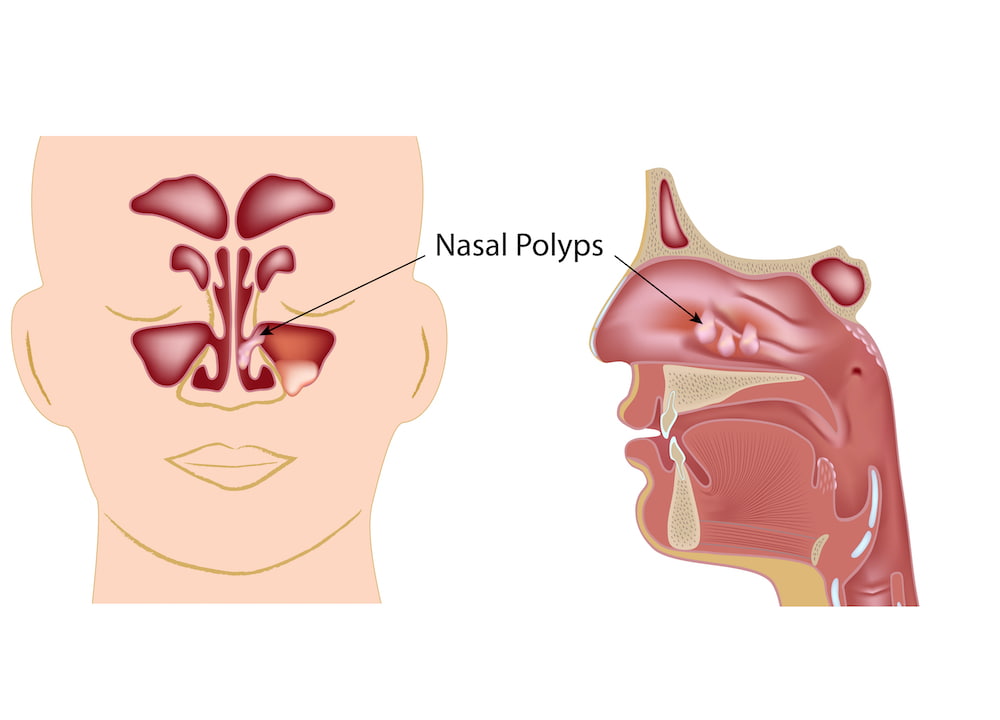 nasal polyps graphic