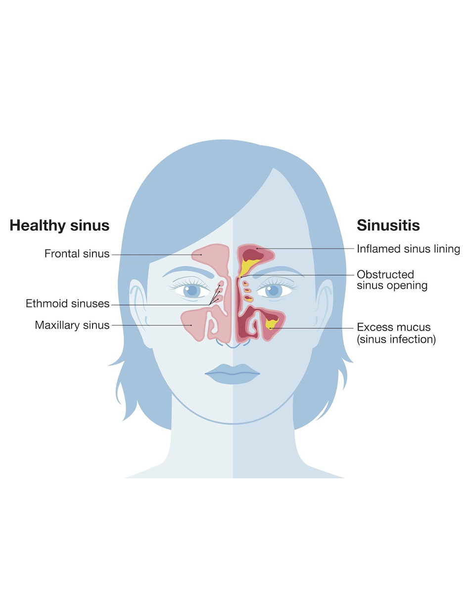 sinusitis graphic